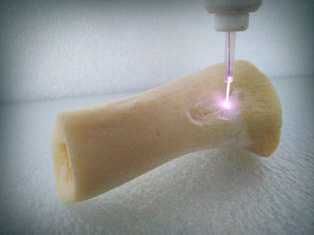 Treating Bone Cancer with Plasmas.